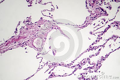 Diffuse emphysema, light micrograph Stock Photo