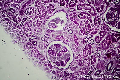 Diffuse proliferative glomerulonephritis Stock Photo