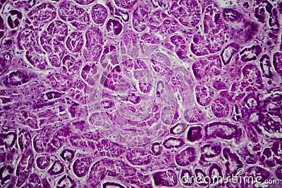 Diffuse proliferative glomerulonephritis Stock Photo