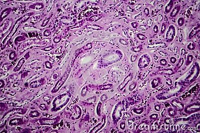 Diffuse proliferative glomerulonephritis Stock Photo