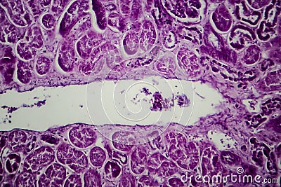 Diffuse proliferative glomerulonephritis Stock Photo