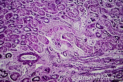 Diffuse proliferative glomerulonephritis Stock Photo