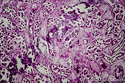 Diffuse sclerosing glomerulonephritis Stock Photo