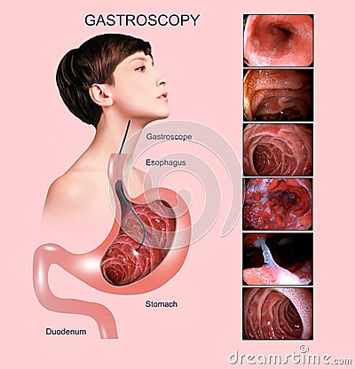 Digestive endoscopy or gastroscopy. Performing a gastroscopy procedure. Diagnostics of gastric diseases. Stomach health. Stock Photo