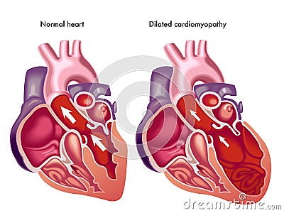 Dilated cardiomyopathy Vector Illustration