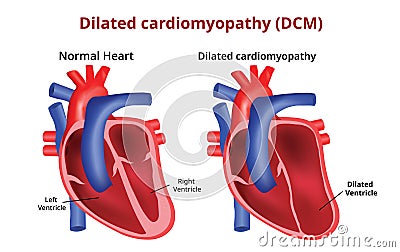 Dilated cardiomyopathy, Heart disease, Vector image Vector Illustration