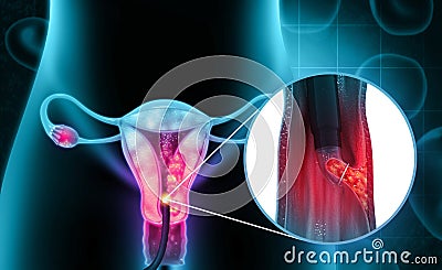 Dilation and curettage (d and c).endometrial biopsy.cervical cancer Cartoon Illustration
