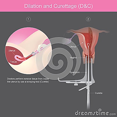 Dilation and Curettage. Vector Illustration