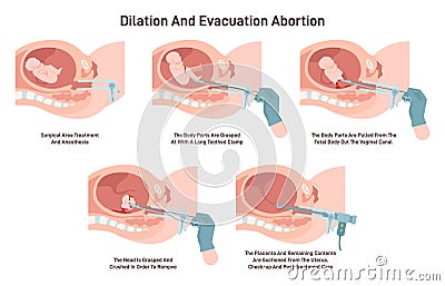 Dilation and evacuation abortion. Gynecology surgery. Embryo Vector Illustration