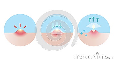 Acne pimple patch for pustule vector icon set illustration on white background. Cartoon Illustration