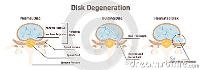 Disc degeneration stages set. flat Spine vertebrae anatomy scheme, Vector Illustration