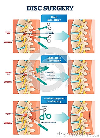 Disc surgery vector illustration. Diagram with back nerves and bones pain. Vector Illustration