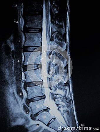 Discogenic pathology extrusion nerve root mri exam Stock Photo