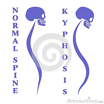 Disease of a spine. Kyphosis. Body posture defect. Blue skull with a silhouette of the spine. Vector illustration. Vector Illustration