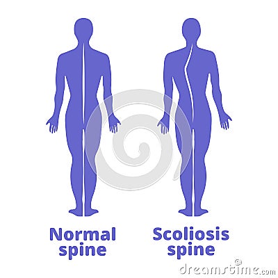 Disease of a spine. Scoliosis. Body posture defect. Blue human silhouettes . Vector illustration. Cartoon Illustration