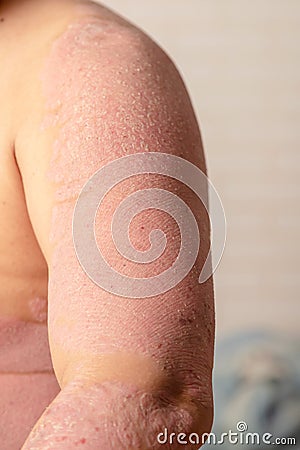 Diseases caused by abnormalities of the lymph. Psoriasis is a skin disease Stock Photo