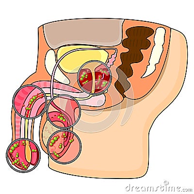 Diseases of male reproductive system Vector Illustration