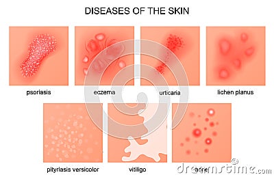 Diseases of the skin Vector Illustration