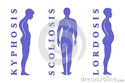 Diseases of the spine. Scoliosis, lordosis, kyphosis. Body posture defect. Human silhouettes on white. Vector illustratio Vector Illustration