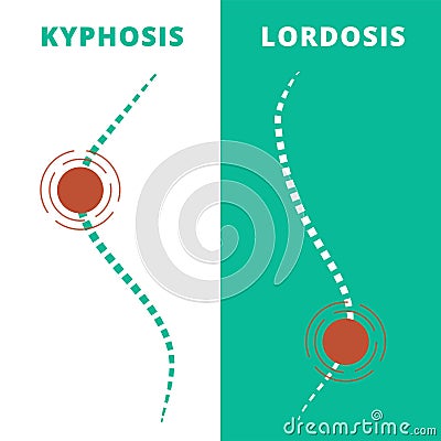 Diseases of the spine. Spinal pain. Lordosis, kyphosis. Body posture defects. Back curvature. Spinal deformity types Vector Illustration