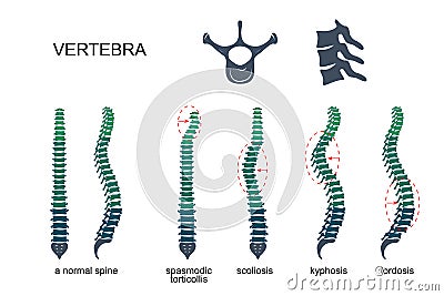 Diseases of the spine Vector Illustration