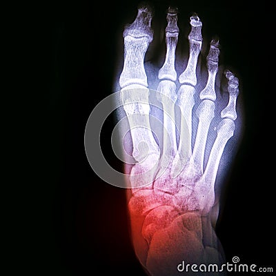 Dislocation of the ankle or arthritis of the joint. X-ray of the foot with the designation of the sore spot Stock Photo