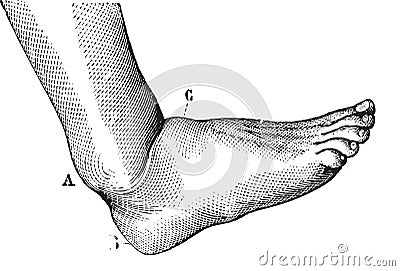 Dislocation of the foot forward, vintage engraving Vector Illustration