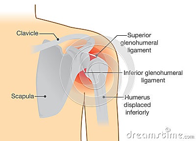 Dislocation Shoulder symptoms or separated. Vector Illustration