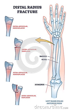 Distal radius fracture and broken arm bone types anatomy outline diagram Vector Illustration