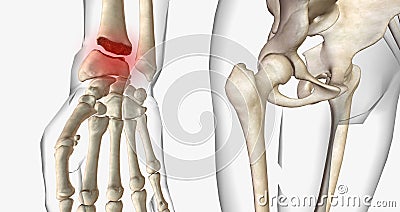 Distal radius fractures are among the most common types of fractures and are most common in the upper extremities Stock Photo