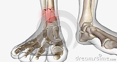 Distal tibia fractures affect the ankle joint and can often involve a fracture of the fibula Stock Photo