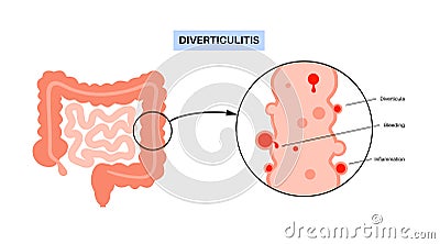 Diverticulitis and diverticulosis Vector Illustration