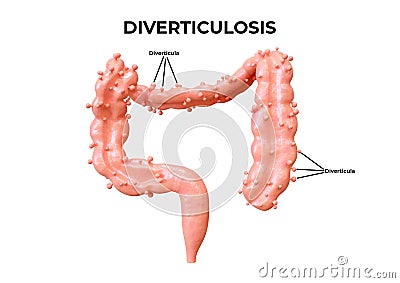 Diverticulosis is a gastrointestinal disorder in which diverticula form in the intestine Cartoon Illustration