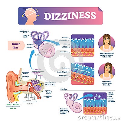 Dizziness vector illustration. Labeled scheme with inner ear and vertigo. Vector Illustration