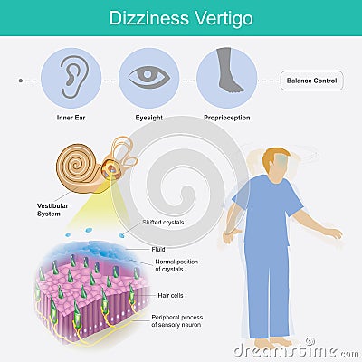 Dizziness Vertigo. Illustration explain dizziness vertigo by cause of crystals can float into the wrong part of the inner ear Vector Illustration