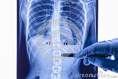 Doctor analyzing X ray of the spine showing scoliosis in the lumbar area Stock Photo