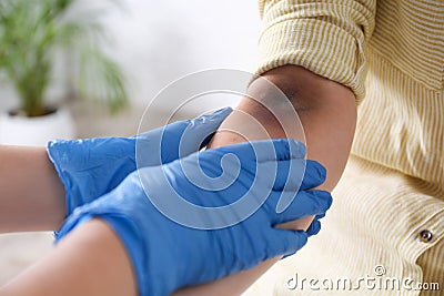 Doctor checking woman`s elbow with bruise at hospital, closeup Stock Photo