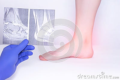 The doctor conducts a medical examination of the ankle joint using an x-ray to detect the disease of arthrosis, diagnostics Stock Photo