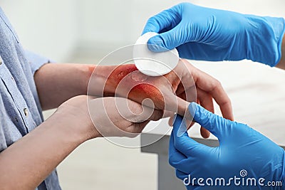 Doctor covering patient`s burn of hand with cotton pad indoors, closeup Stock Photo