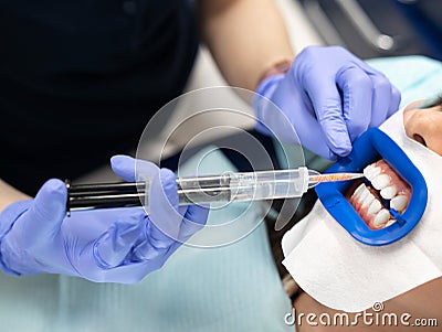 Doctor dentist performs a procedure for whitening teeth with a special gel from a syringe Stock Photo