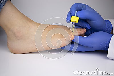 The doctor dermatologist drops the medicine with a pipette on the nail affected by the fungus. Antimycotic therapy. Treatment of Stock Photo