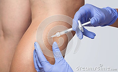 A doctor does medical procedure Sclerotherapy used to eliminate varicose veins and spider veins. An injection of a solution Stock Photo