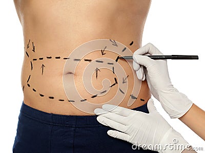 Doctor drawing marks on man`s body for cosmetic surgery operation against white background Stock Photo