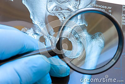 Doctor examines MRI snapshot of hip joint with magnifying glass. Careful diagnosis rare and occurs widely hip joint diseases such Stock Photo