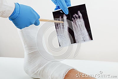 Doctor examines x-ray image, broken leg of the patient in plaster lying on the couch Stock Photo