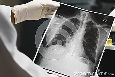 Doctor examining a lung radiography, Doctor looking chest x-ray film. Stock Photo