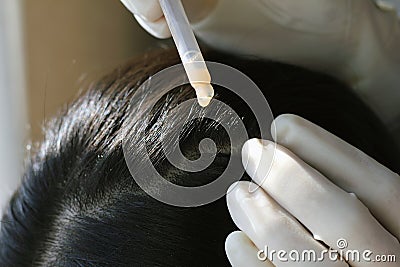 Doctor giving a treatment at patient`s hair and scalp, Close up shot of Dermatologist exam scalp disorder. Stock Photo