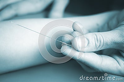 Doctor hand acupuncture needle patient arm Stock Photo