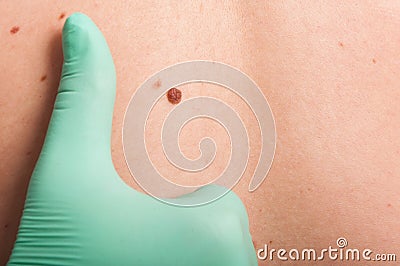 Doctor hand examine skin mole Stock Photo