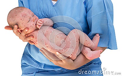 Doctor holding a newborn baby which is sick rubella Stock Photo